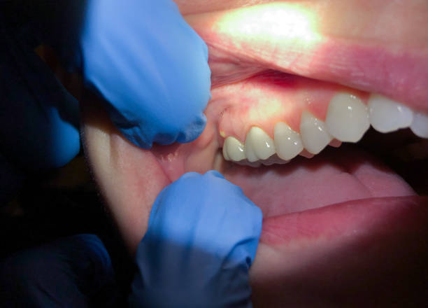 Best Emergency Wisdom Teeth Removal in Glencoe, IL